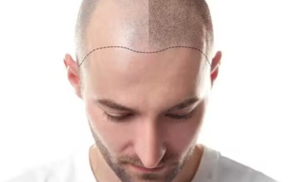 Micropigmentação capilar: conheça o procedimento para tatuar couro cabeludo em pessoas calvas